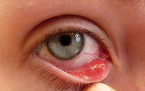 Воспаление глазного века