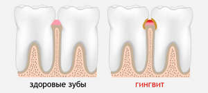 Гингивит и здоровые зубы