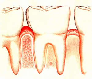 Гингивит зубов