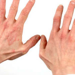 Контактный дерматит на руках