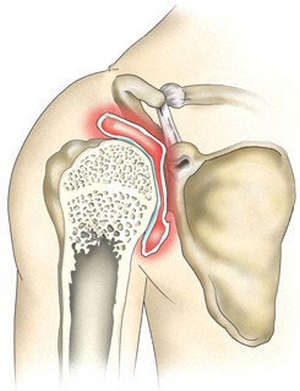 Что такое периартрит плечевого сустава