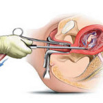Как делают вакуум аборт (мини-аборт) — насколько опасна данная операция