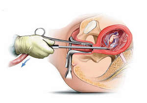 Вакуумный аборт