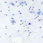 Лейкоциты в урогенитальном мазке
