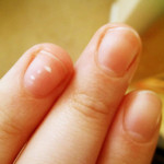 Что значат пятна на ногтях у взрослых и ребенка?