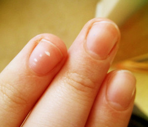Белые пятна на ногте
