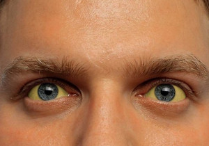 Желтые глаза у мужчины