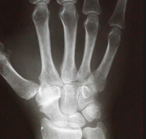 Рентгеновский снимок запястья с гигромой