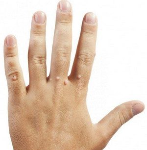 Бородавки на пальцах руки