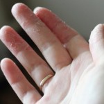 Почему трескается кожа между пальцев на руках?