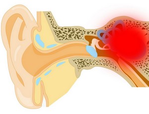 Скопление жидкости в ухе при синдроме Меньера