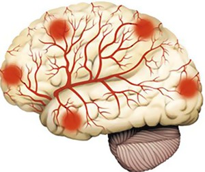 Атеросклеротическая энцефалопатия головного мозга
