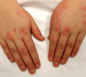 Аллергическая реакция на руках