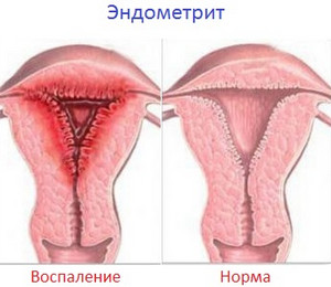 Изображение эндометрита