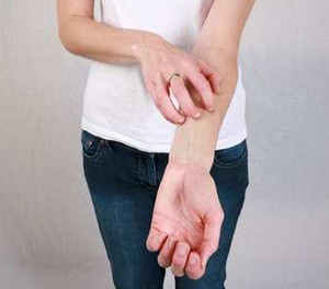 Девушка чешет руку из-за аллергии