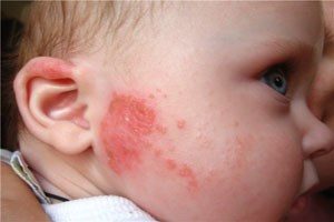 Красная сыпь на щеке у ребенка