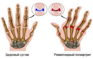 Два изображения - нормальные кости кисти и с ревматоидным полиартритом