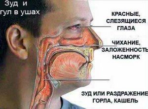 Основные симптоы аллергии на картинке