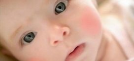 Покраснения на щеках у ребенка