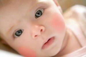 Покраснения на щеках у ребенка