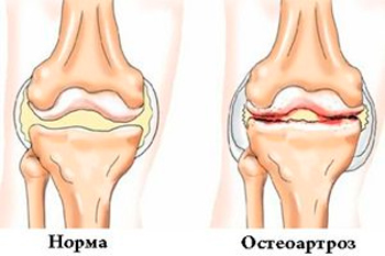 как развивается остеоартроз коленного сустава