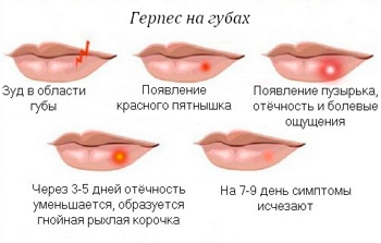 Герпес на губах при беременности: эффективное лечение и предосторожности