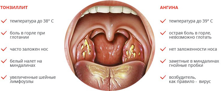 Раствор люголя: инструкция по применению при болезнях горла