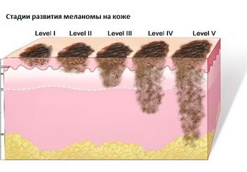 меланома кожи начальная стадия