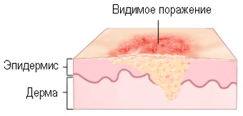 стадии меланомы кожи