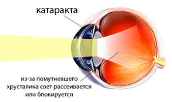 катаракта без операции, методы лечения