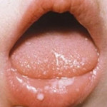 Афты во рту у детей: причины и лечение