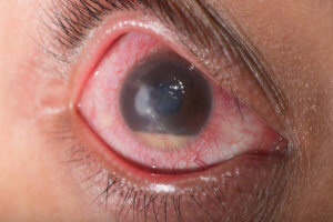 Вторичная глаукома: как избежать полной слепоты