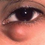 Воспаление века глаза: причины, симптомы. Методы лечения воспаления века глаза