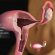 Кожный пластырь: новый метод долговременной контрацепции
