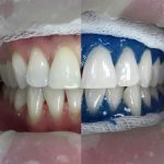 Как отбелить зубы в домашних условиях без вреда для зубной эмали? Эффективные средства домашнего отбеливания зубов