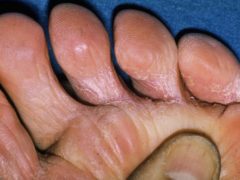 Грибок между пальцами ног – чем лечить в домашних условиях?