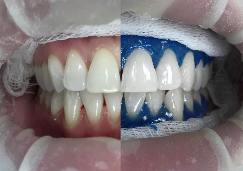 Чистка зубов с отбеливанием спб подставка для насадок зубной щетки