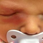 Зондирование слёзного канала у новорождённого – зачем? Показания к проведению зондирования слёзного канала у новорождённого