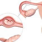Как самостоятельно определить внематочную беременность. Современные способы лечения внематочной беременности