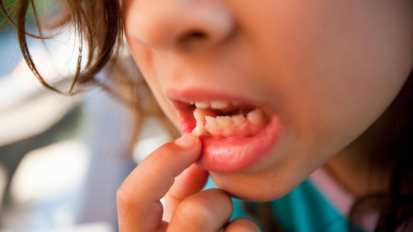 Расшатывание и выпадение зубов