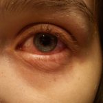 Воспаление оболочки глаза: причины, симптомы. Лечение воспаления радужной оболочки глаза