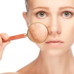 Купероз на лице – причины появления сосудистого рисунка на носу и щеках. Каковы симптомы купероза и как его лечить?
