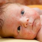 Акне новорождённых: основные причины и последствия. Акне новорождённых — что делать, если появилась угревая сыпь