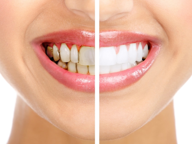 Зубной камень – как удалить в домашних условиях быстро и эффективно. Лучшие способы для борьбы с зубным камнем