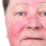 Розацеа на лице — первые симптомы, стадии, причины и возможные осложнения. Лечение и профилактика розацеа на лице