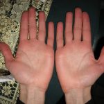 Покалывание в пальцах рук: симптомы, диагностика, лечение. Когда бывает покалывание в пальцах рук и что делать с этим