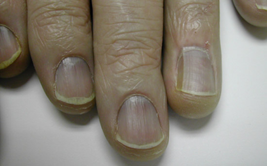 диагностика по ногтям