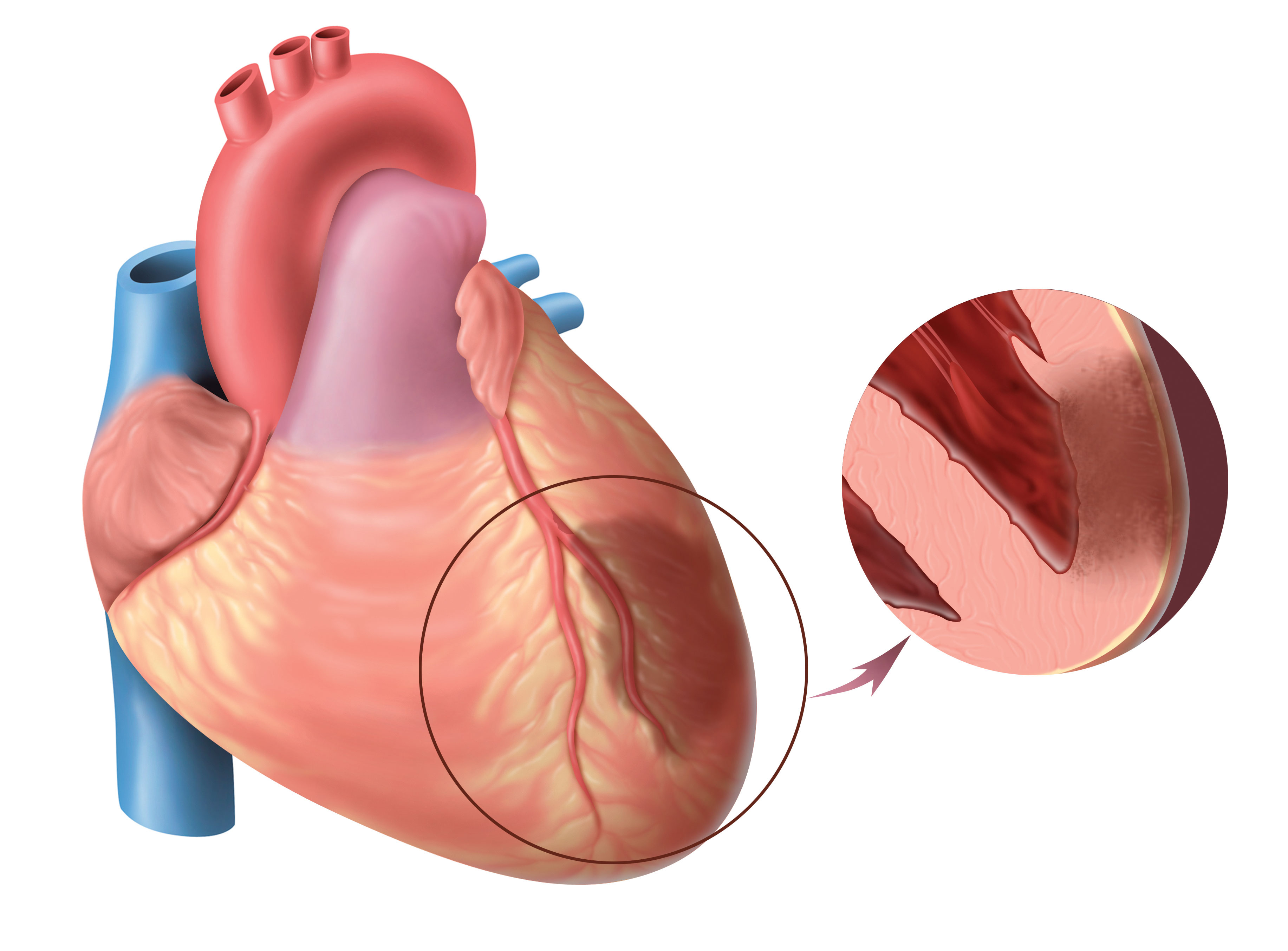 Гастралгической форме инфаркта миокарда