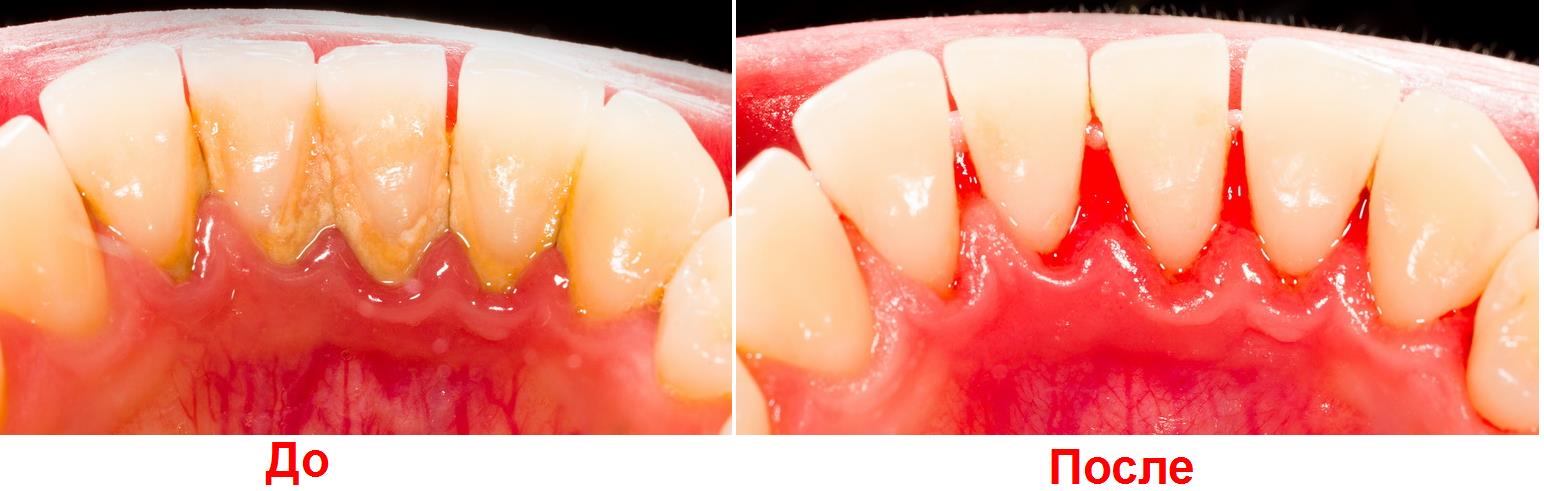 фото до удаления зубного камня ультразвуком и после