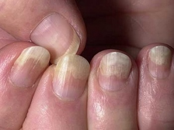 Отслоение ногтей - один из признаков онихомикоза